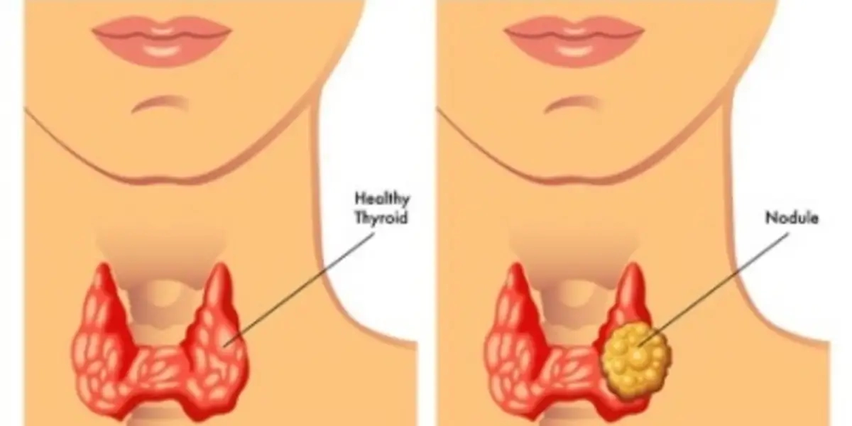Thyroid screening