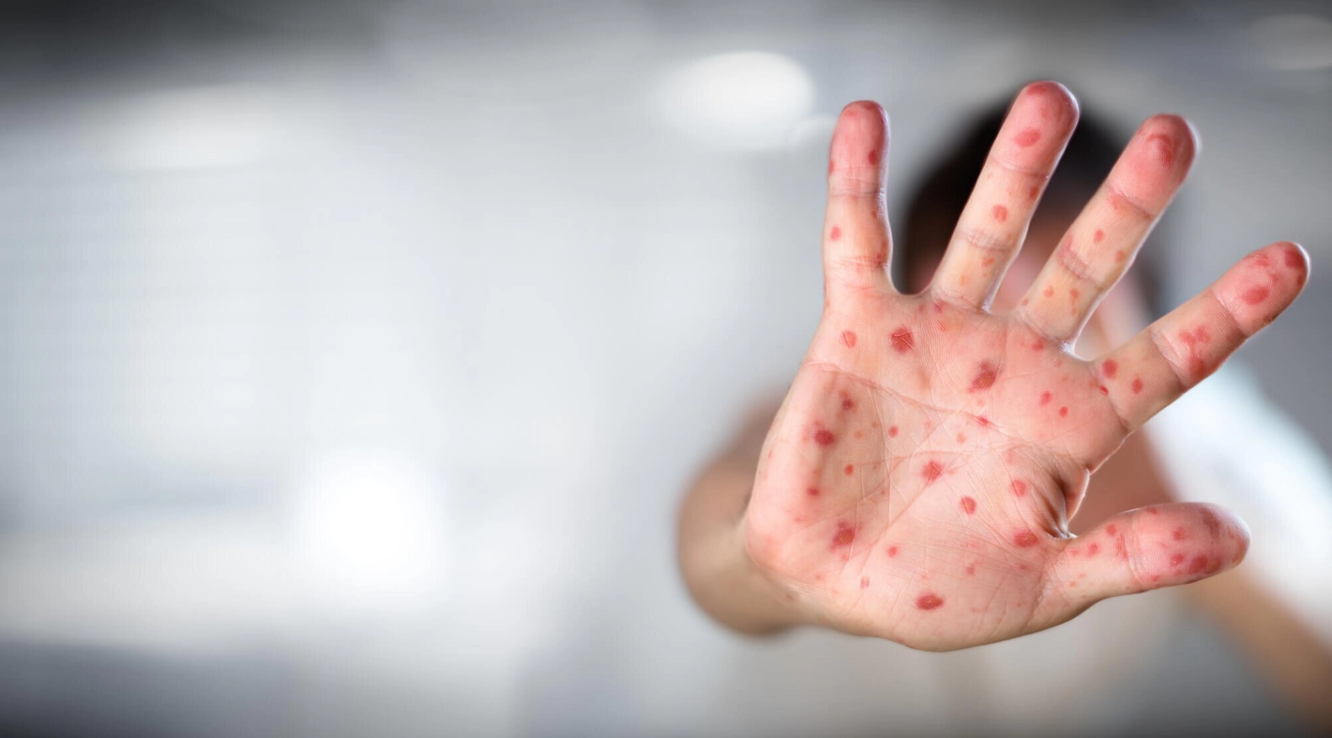 Rubella