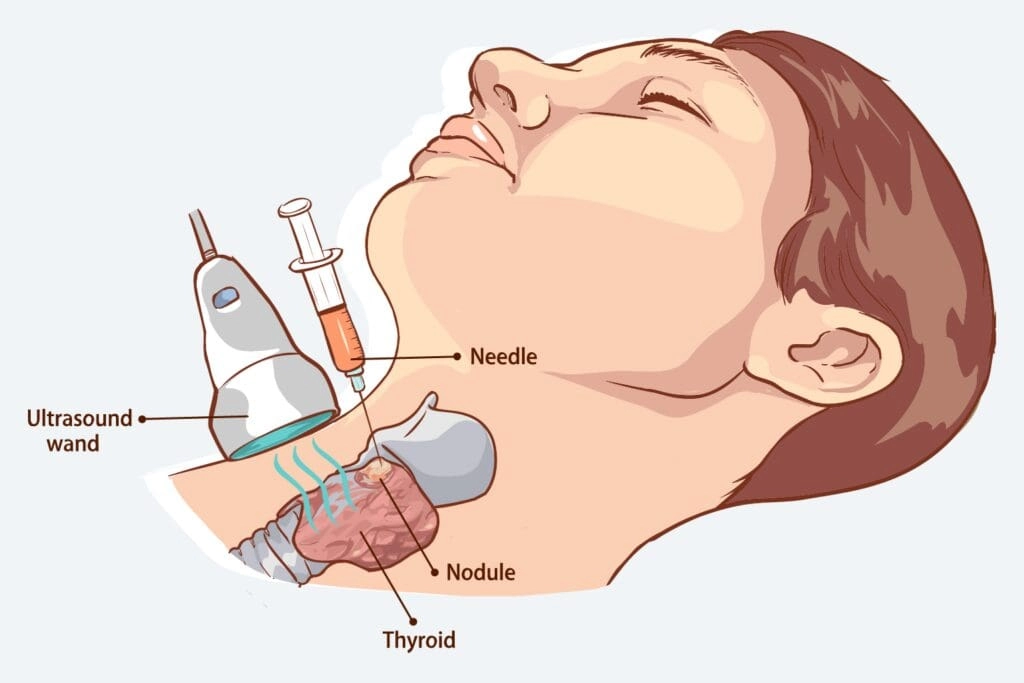 Thyroid screening